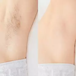 Deodorant that stops hair growth by Epil Star